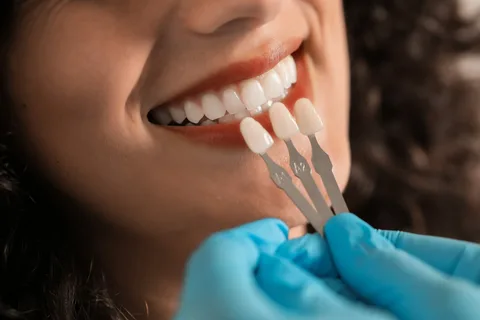 What looks more natural than veneers?