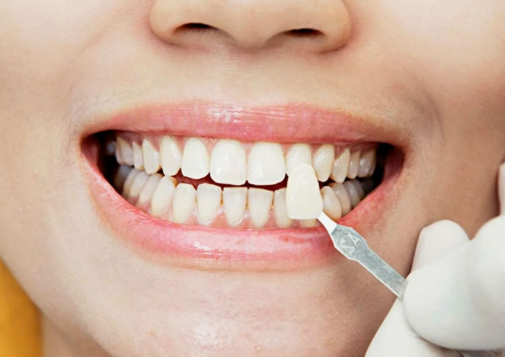 What happens after 20 years of having veneers
