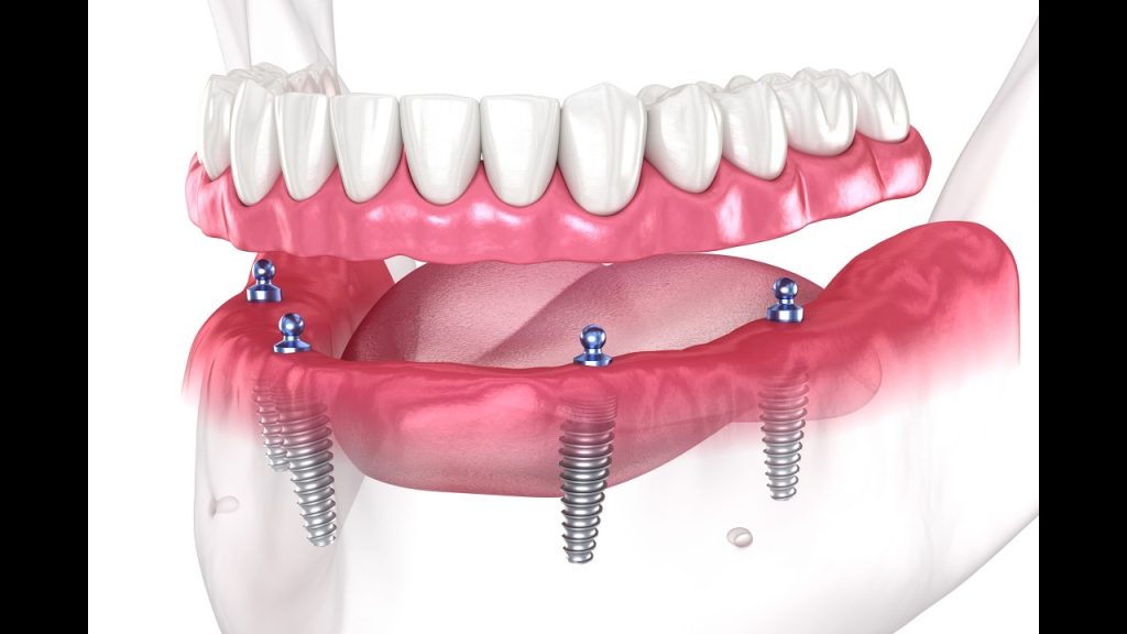 t 4 teeth on 2 implants