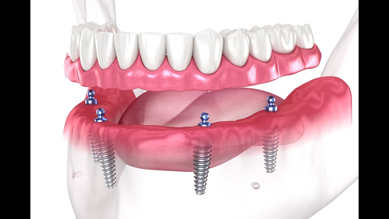 t 4 teeth on 2 implants