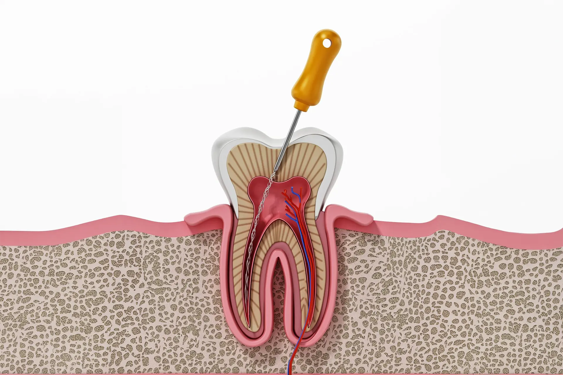 What happens 10 years after a root canal?